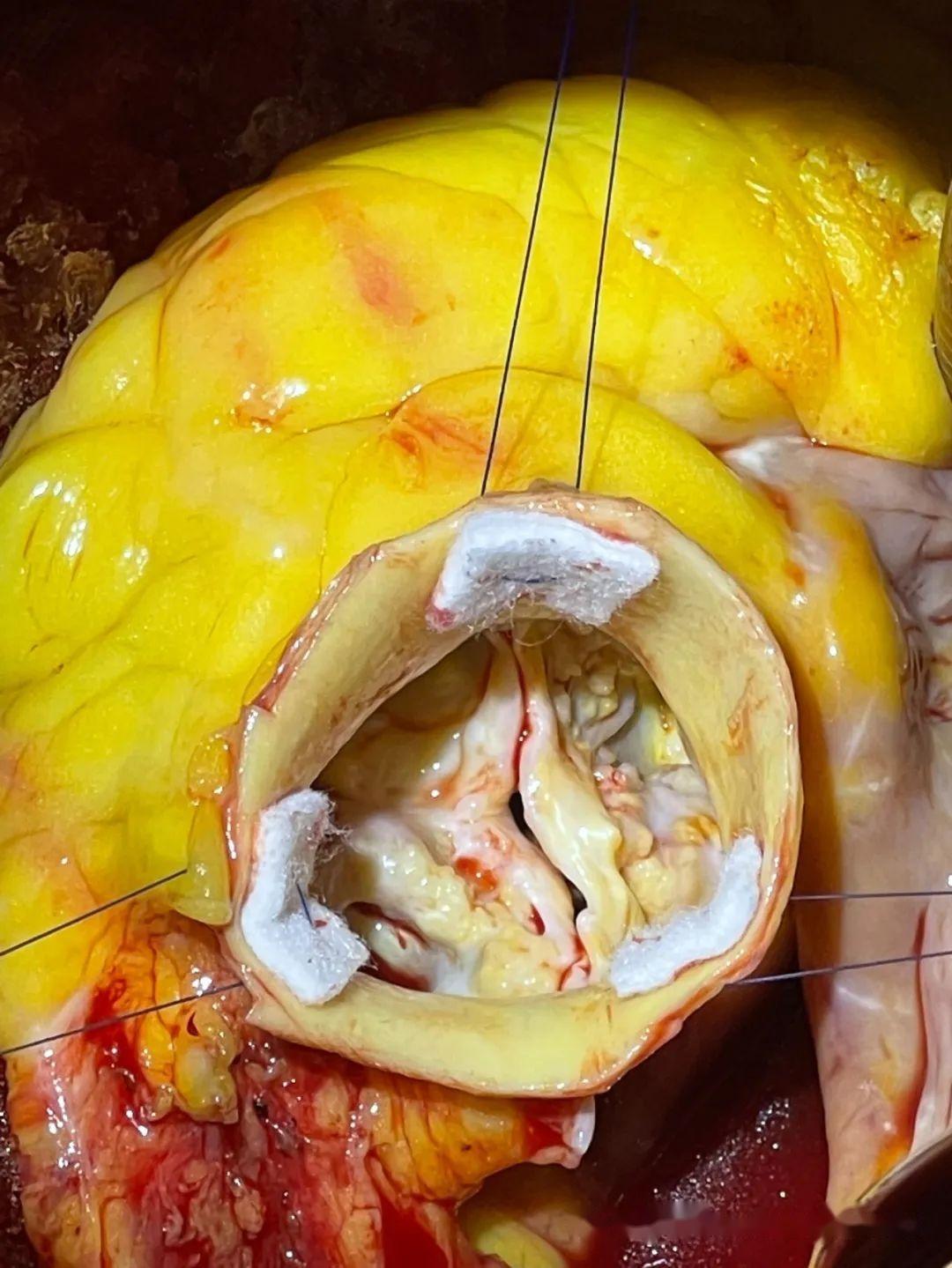 心脏健康报告:瓣膜性心脏病的全球流行趋势