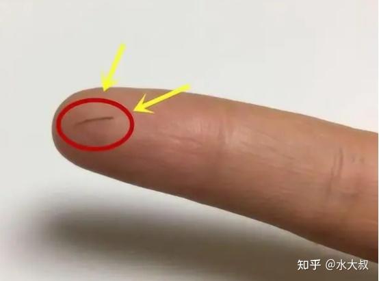 手上扎了刺千万别用针挑,教你两种方法,让刺自己跑出来! - 知乎