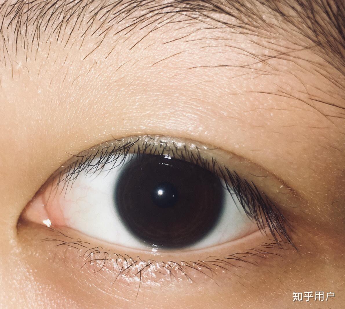 什么是双睫症身边有这样的朋友吗