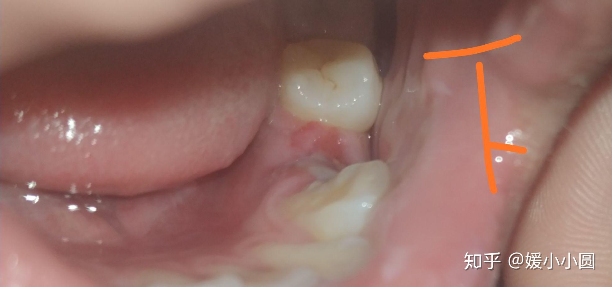 牙齿矫正拔牙恢复篇有图可能有点血腥