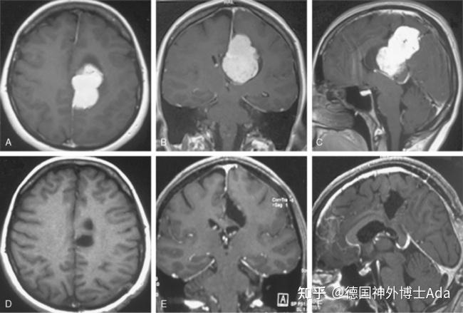 脑膜瘤的临床表现有哪些？详细解读不同位置脑膜瘤症状 知乎