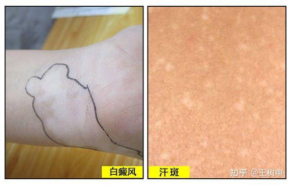 常被误认成白癜风的这类白斑花斑藓流汗是凶手