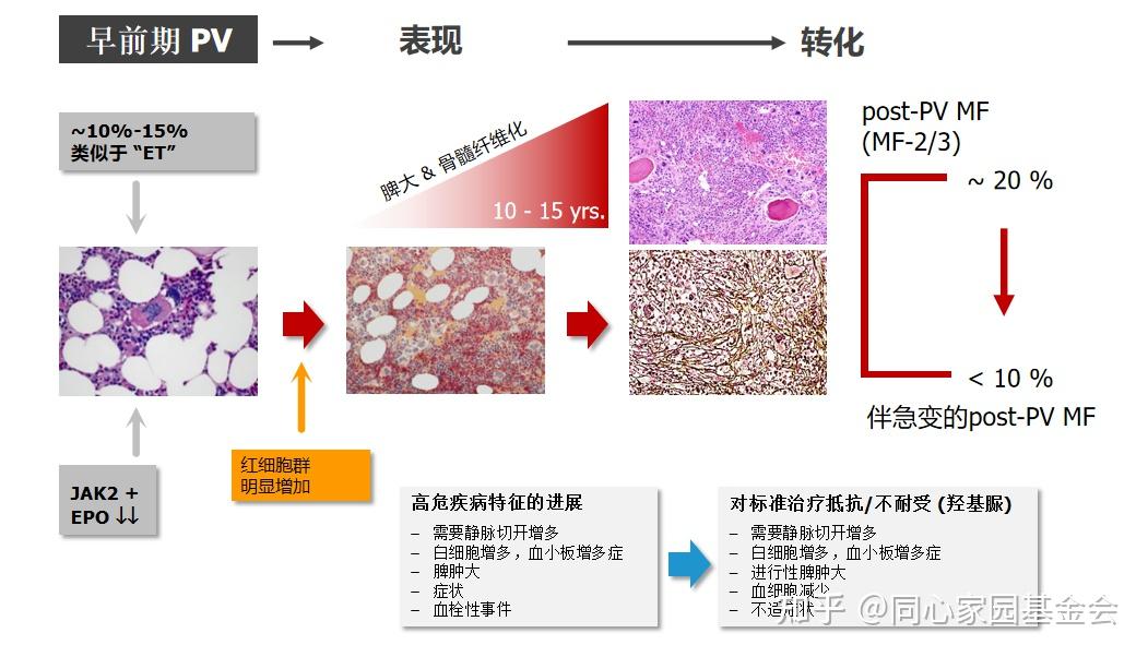 专家讲座真性红细胞增多症pv的概述及最新进展上