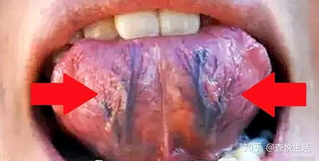 2分钟看明白 舌头下有青筋到底是怎么回事 越早知道越好 舌头底下血管发紫还粗 Urpimp网