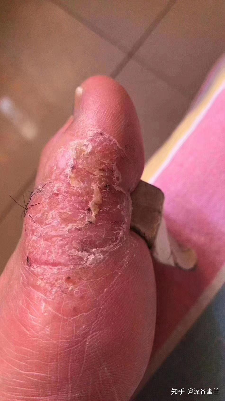 6年脚气脚臭王如何45天逆袭脚模天使听大三女生自述