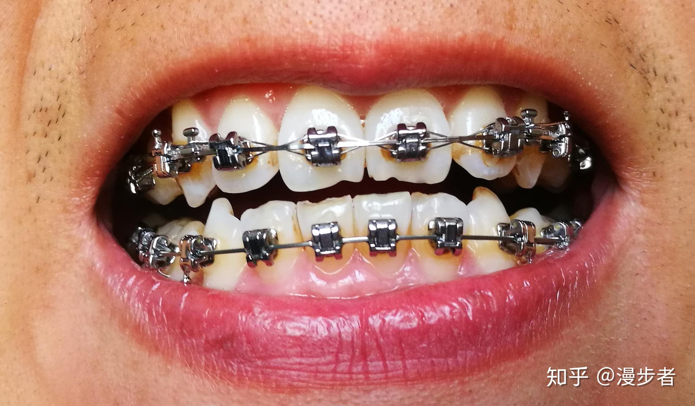 牙齿矫正——自锁托槽矫正流程 - 知乎