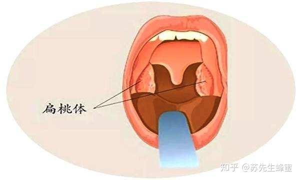 扁桃体发炎蜂蜜有用吗 喉咙痛喝蜂蜜怎么喝 看完就知道了 知乎