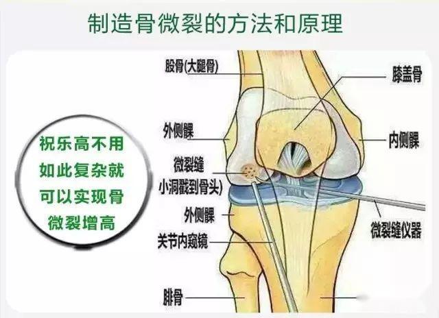 骨微裂锻炼实例——摸高锻炼让我长高了13厘米 ！ - 知乎