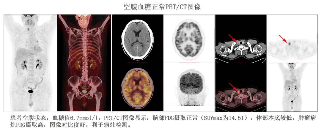 血糖高可以做PET/CT吗？ - 知乎