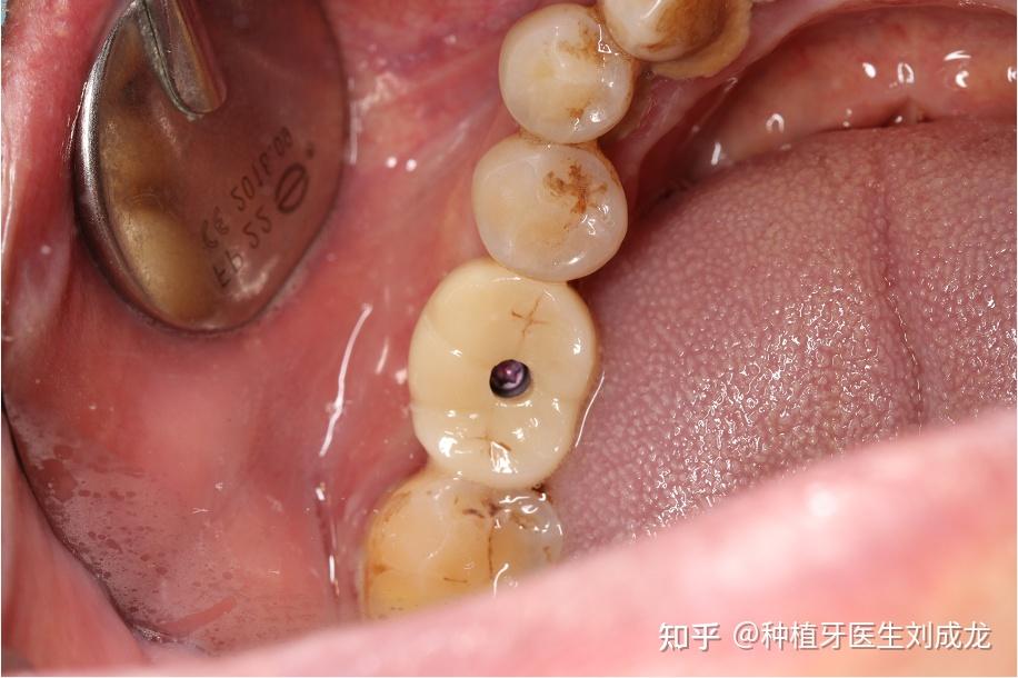 郑州瑞士iti种植牙医生刘成龙72岁患者磨牙区单颗种植案例