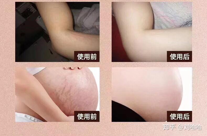 告别妊娠纹