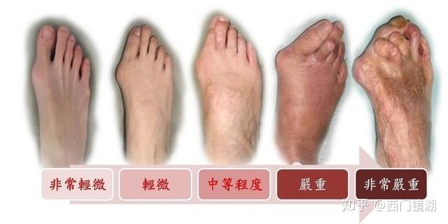 足弓高低与足内翻足外翻的关系