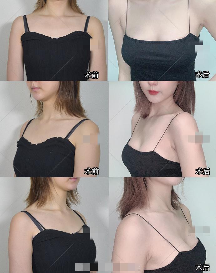 怎么做才能丰胸呢 v2-b80473c150cd8143bdad6f5e6e4bf407_1440w.jpg?source=172ae18b