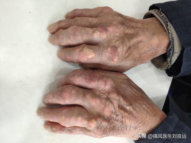 尿酸高危害大排出尿酸的方法有哪些