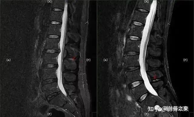 腰椎间盘突出ct片子怎么看教你看腰椎间盘突出ct影像学表现