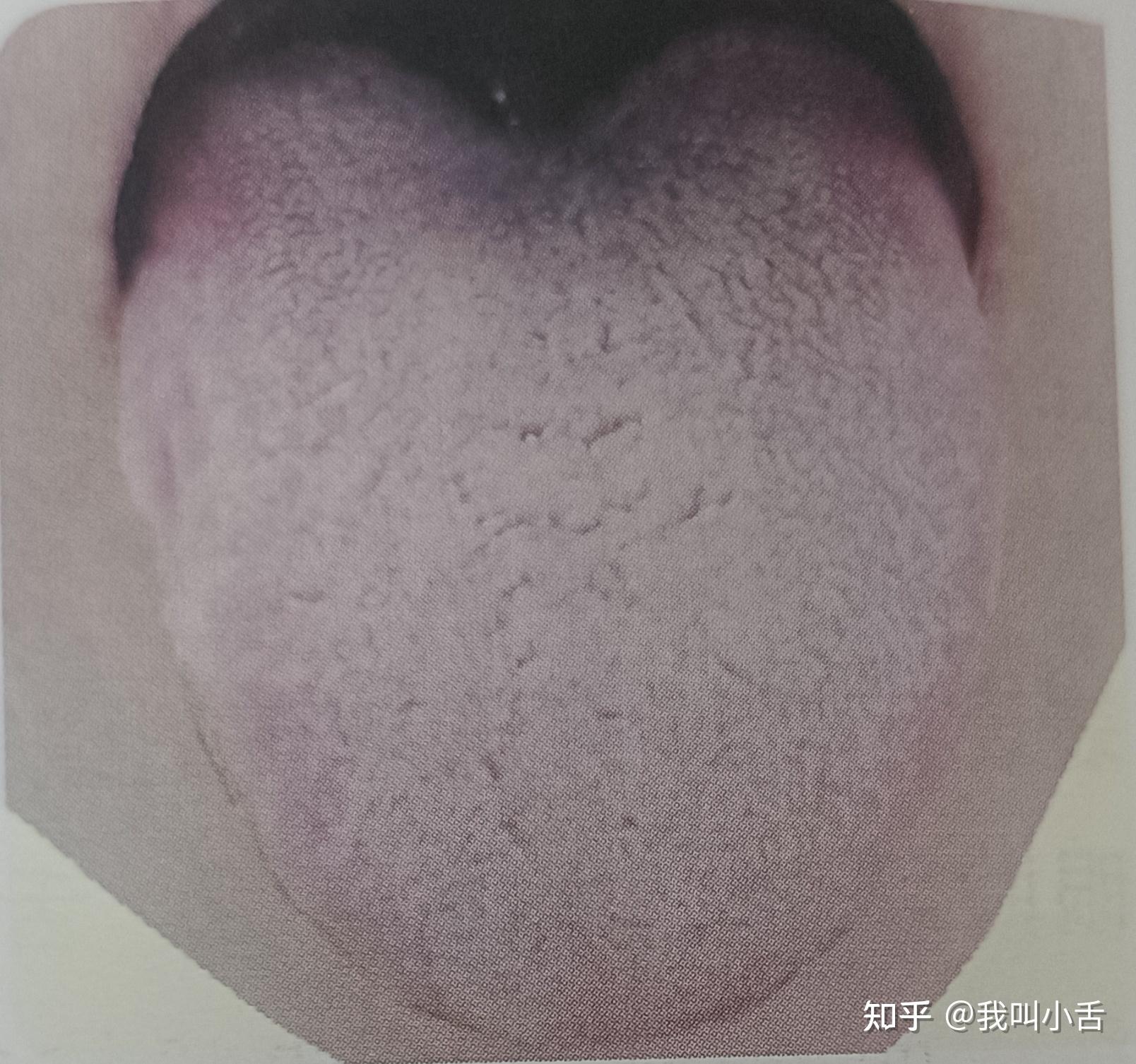 舌苔是如何形成的？白苔长什么样？如何判断自己的舌象呢？智能舌象助手来帮你！ - 知乎