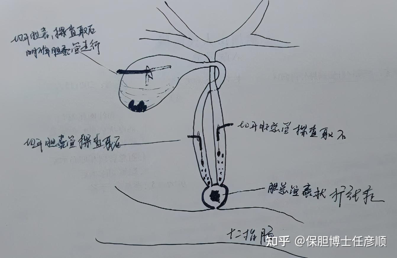 奥迪括约肌痉挛图片