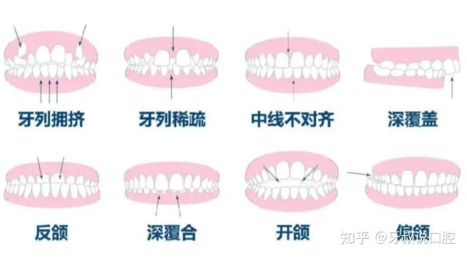 牙齿矫正花多少钱才不算被坑你需要准备多少预算牙齿矫正的费用是怎么