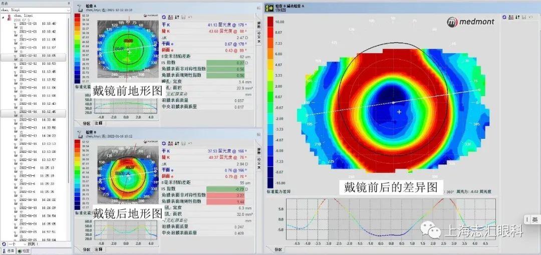 戴了OK镜的地形图怎么看？ - 知乎