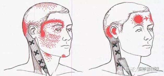 痉挛性斜颈为什么久治不愈?而且越来越严重? - 知乎