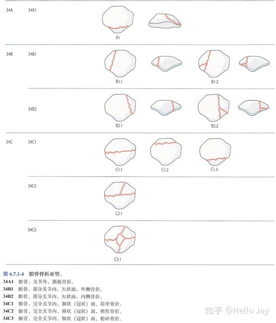 髌骨骨折的治疗原则