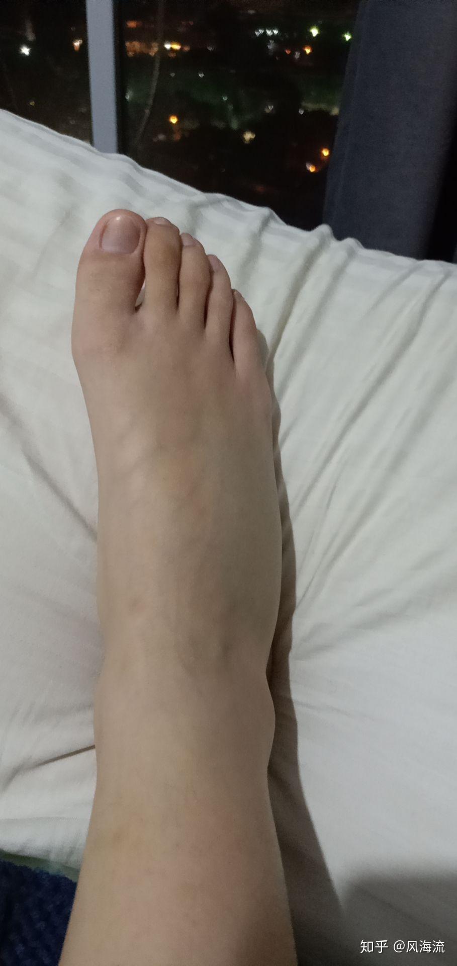 扭伤后脚背有肿块请问怎么消肿