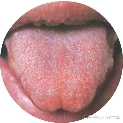 为什么老中医都要看你的舌苔,史上最全舌苔看病大全