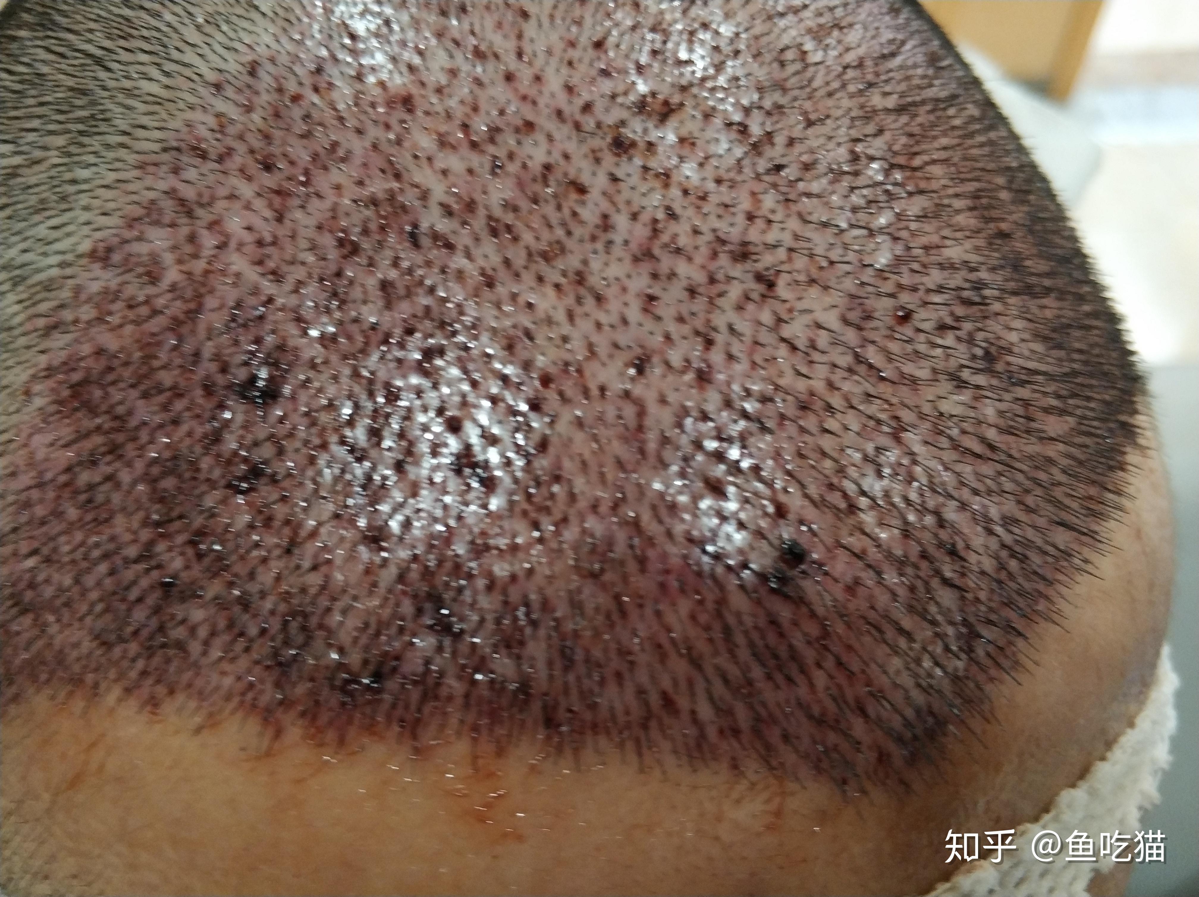 植发手术完当晚(植发手术完当晚睡觉好吗)