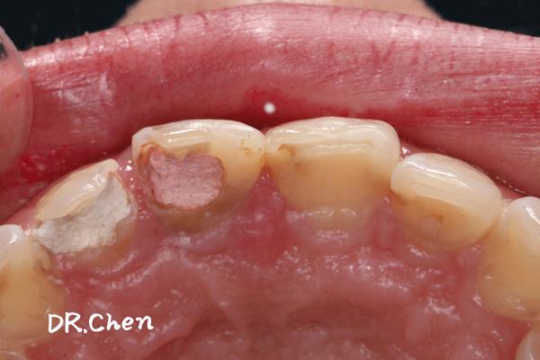 病例展示前牙缺损修复病例