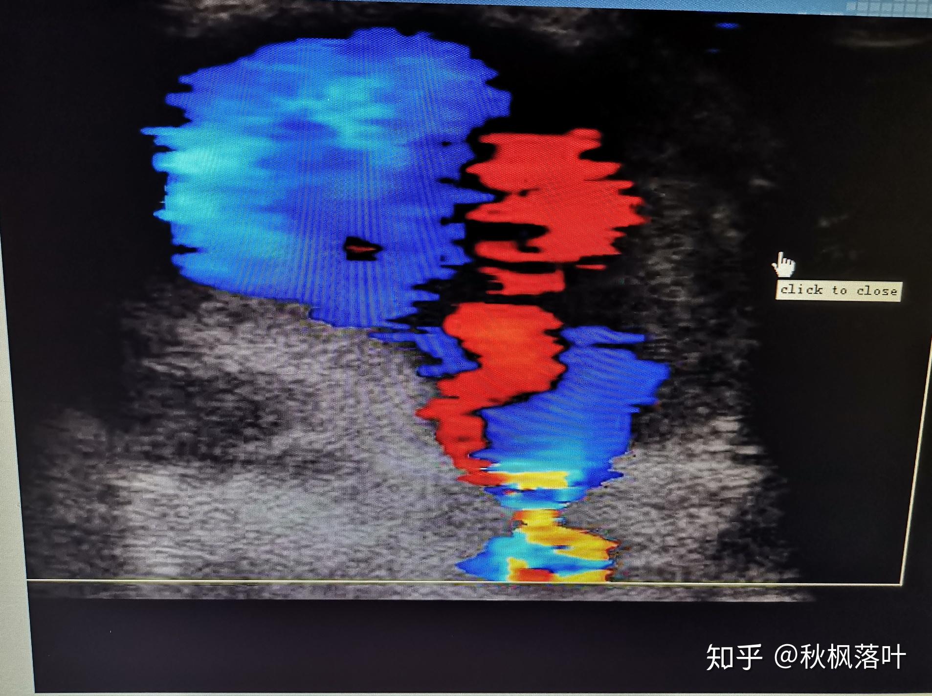 一例肱動脈假性動脈瘤封堵術