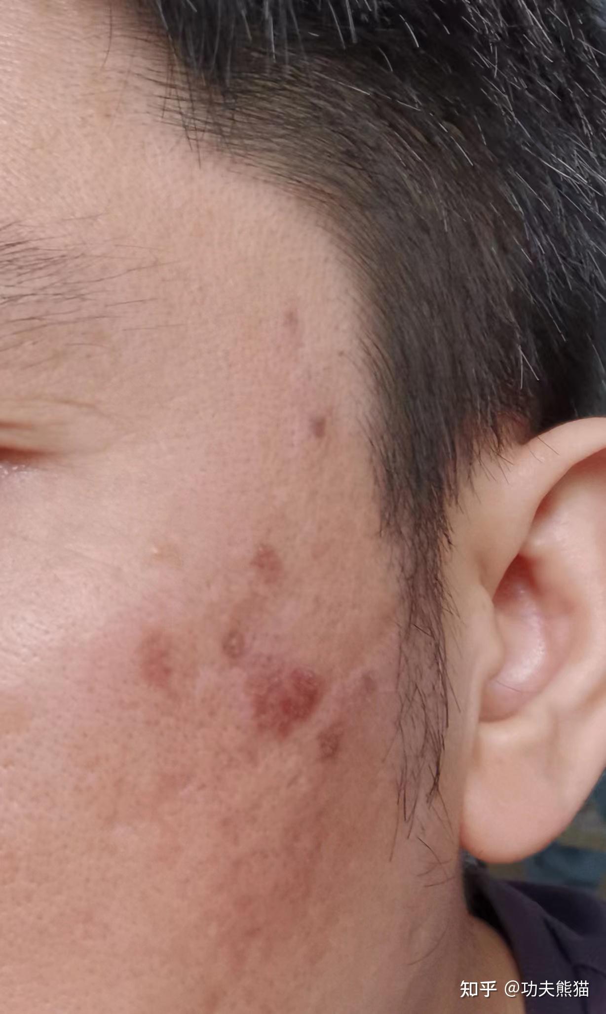 (诊断为老年斑做完激光当天拍摄)我又来到激光治疗的地方.