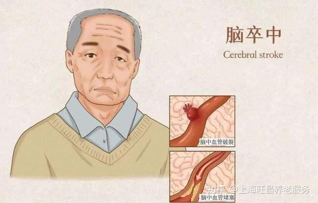 导致中风的因素有哪些?如何预防中风? - 知乎
