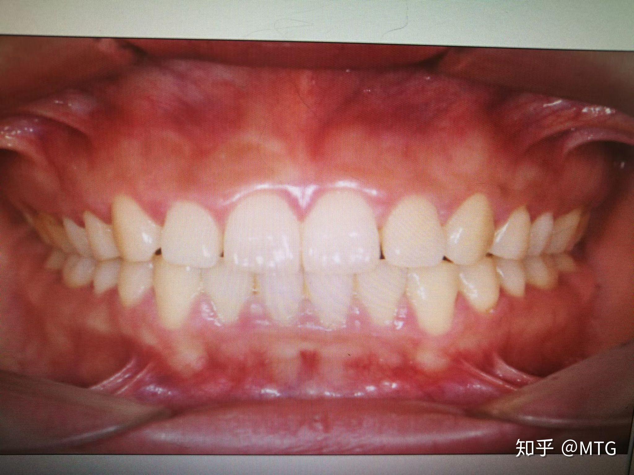 华西口腔正畸失败 - 知乎