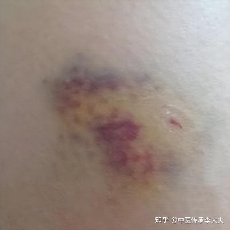 柴胡舒肝丸的神仙搭配，化一身瘀血、痰浊、结节囊肿消失无踪！ - 知乎