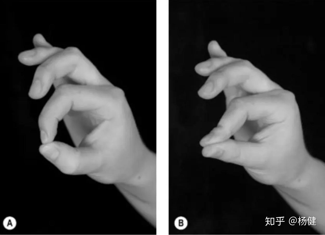 tinels test检查对象:肘管综合征,尺神经(肘管,尺神经沟).