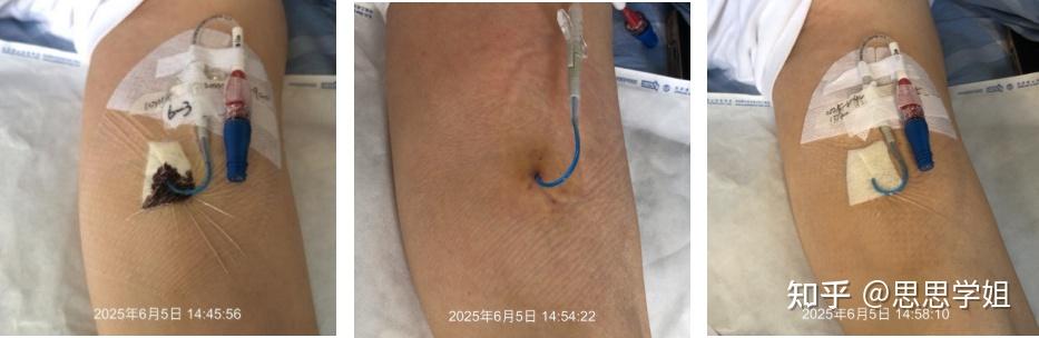 PICC 穿刺点渗血,这 3 种情况需要立即更换敷贴 - 知乎