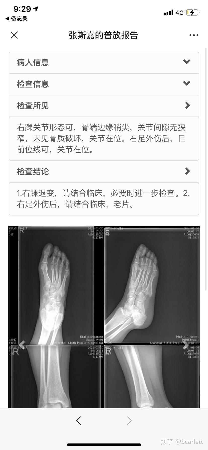 右足第二跖骨骨折图片图片