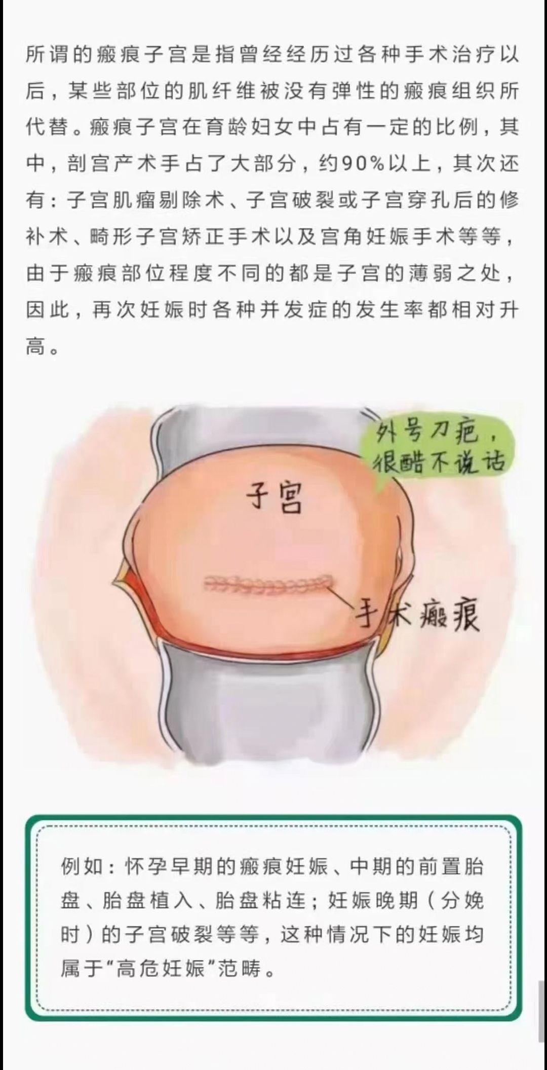 瘢痕子宫做试管婴儿怎么做(疤痕子宫试管可以怀双胞胎吗)-第2张图片-鲸幼网