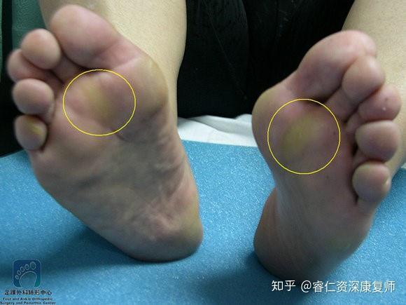 大脚趾外翻,与穿鞋有很大关系!骨科专家超详细讲解! - 知乎