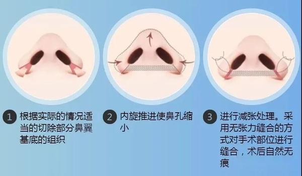 周建:精致感杀手—鼻翼缩小,内切外切的全方位对比【科普篇】 - 知乎