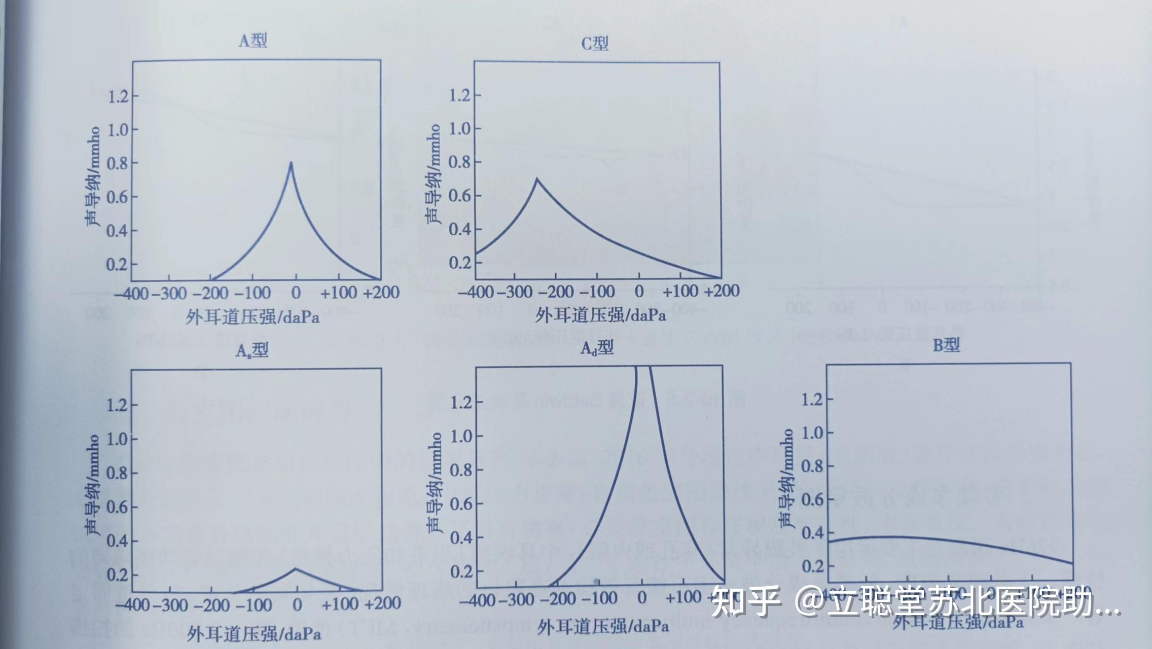 鼓室图分型及其意义图片