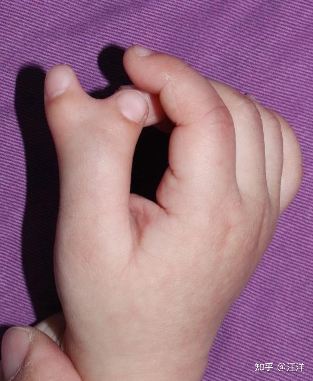 医生我孩子的手指做完怎么还歪