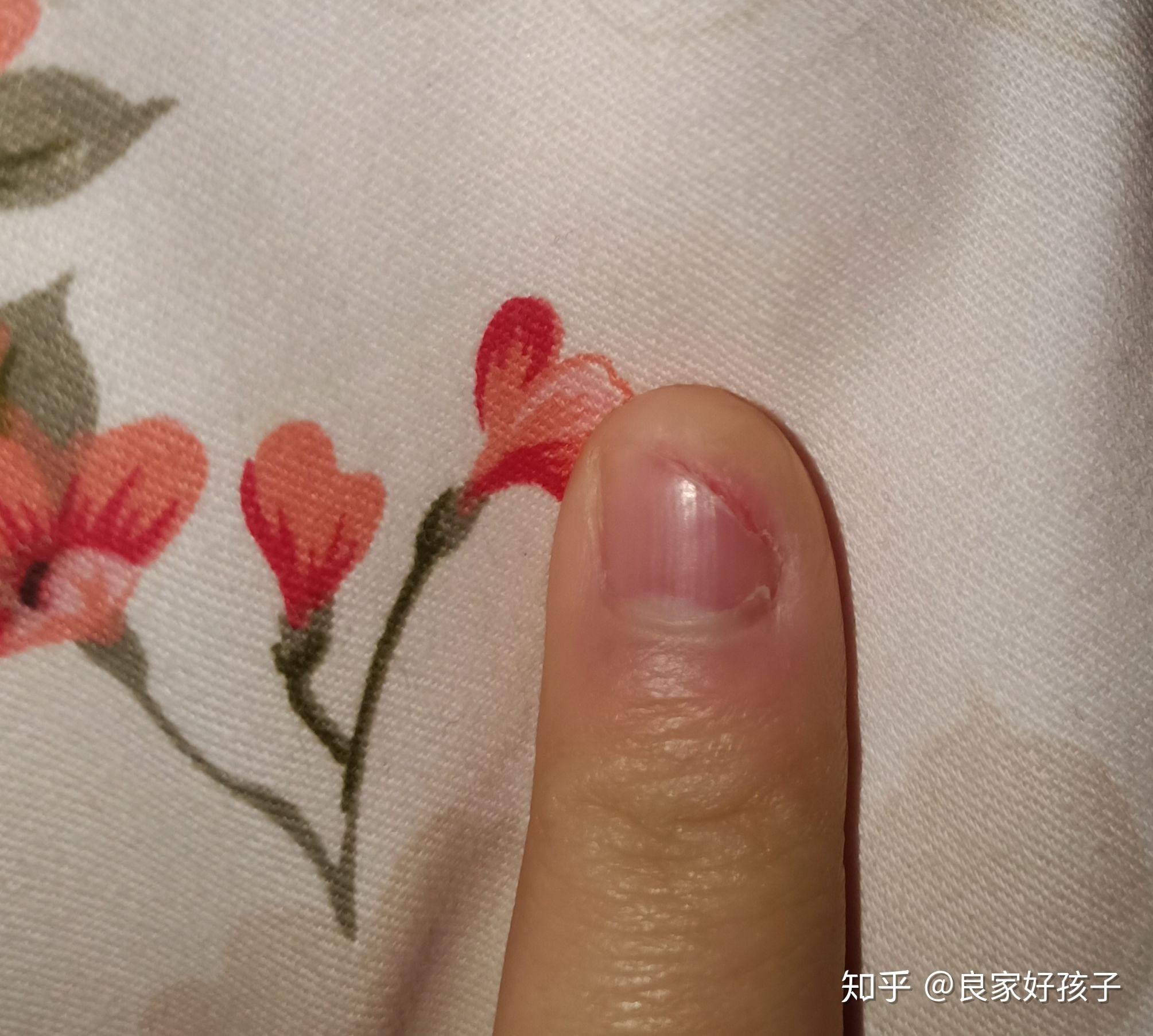 指甲缝干痒脱皮如图