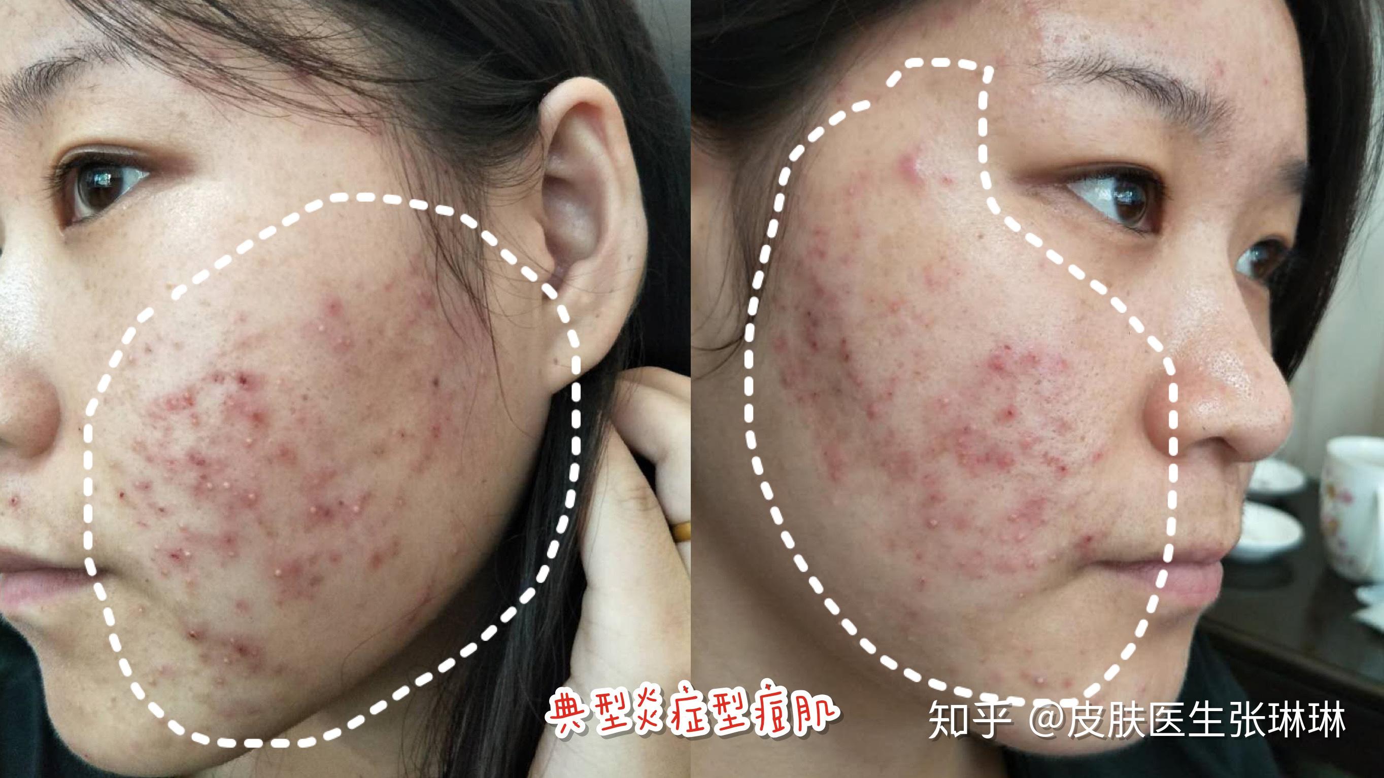 【皮肤医生告诉你】如何快速有效祛痘? - 知乎