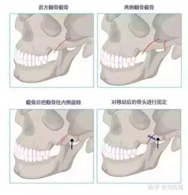 颧骨颧弓整形术干货分享 - 知乎