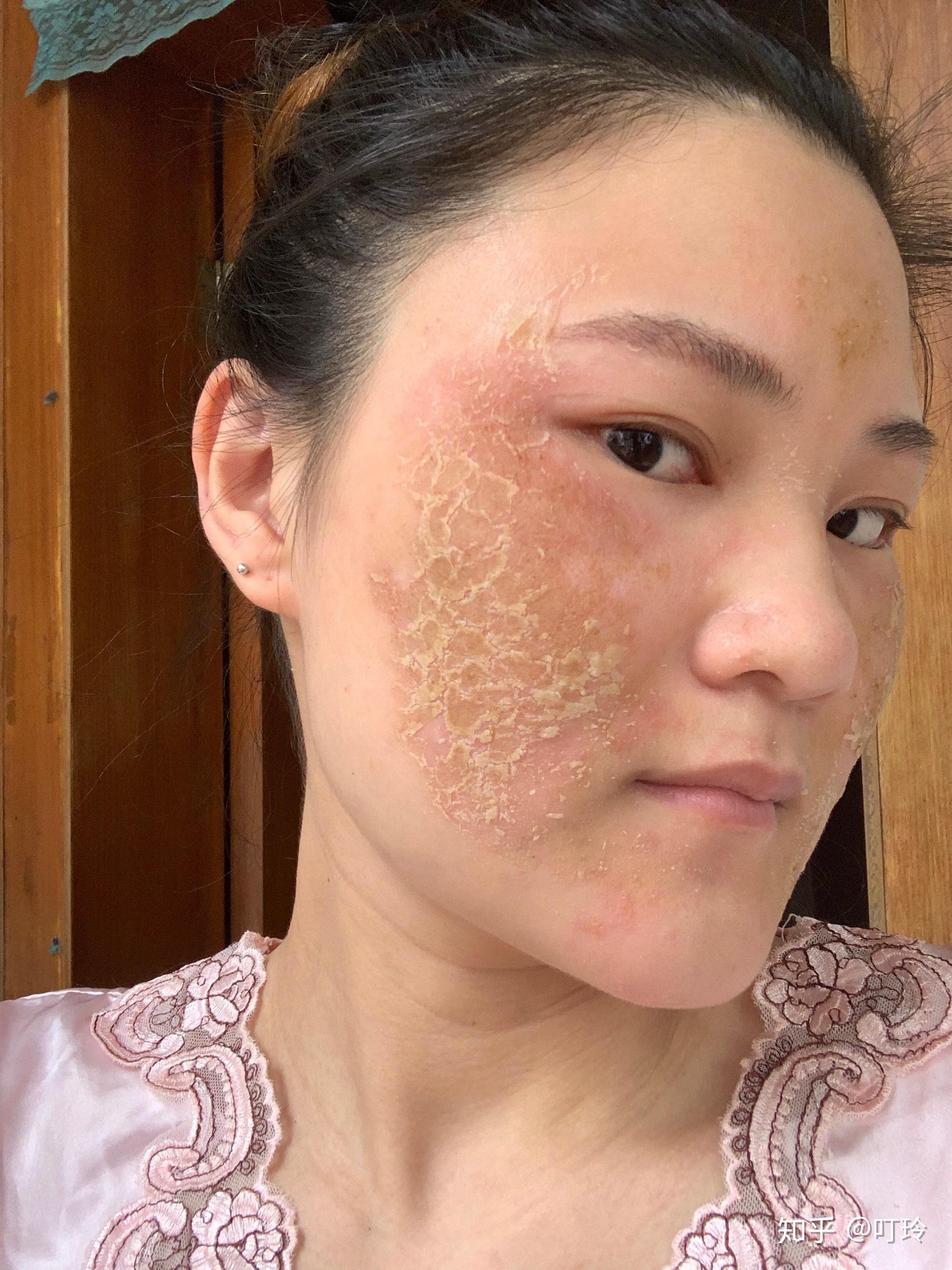 激素脸有哪些症状，怎么看皮肤是不是激素脸？_凤凰网视频_凤凰网