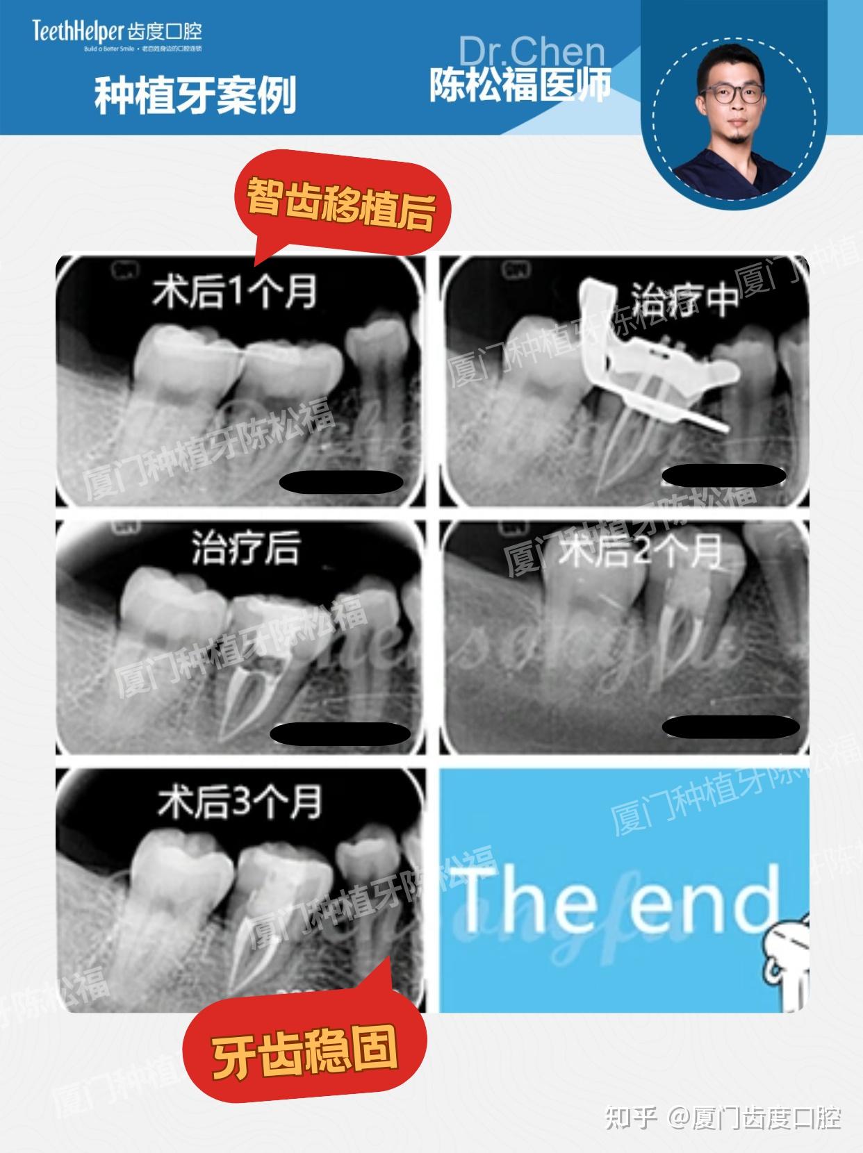 24岁根折救牙记 自体牙移植,把“自己的牙”放回原位 - 知乎