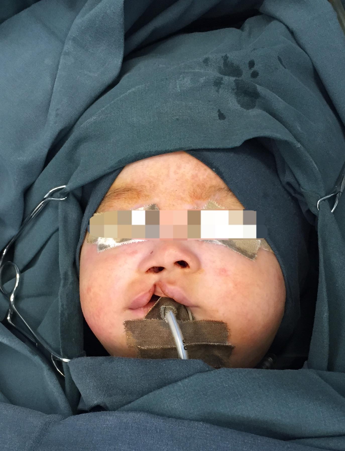 唇腭裂是属于口腔科治疗的范畴,不仅仅是各位想象的那么简单,是一个