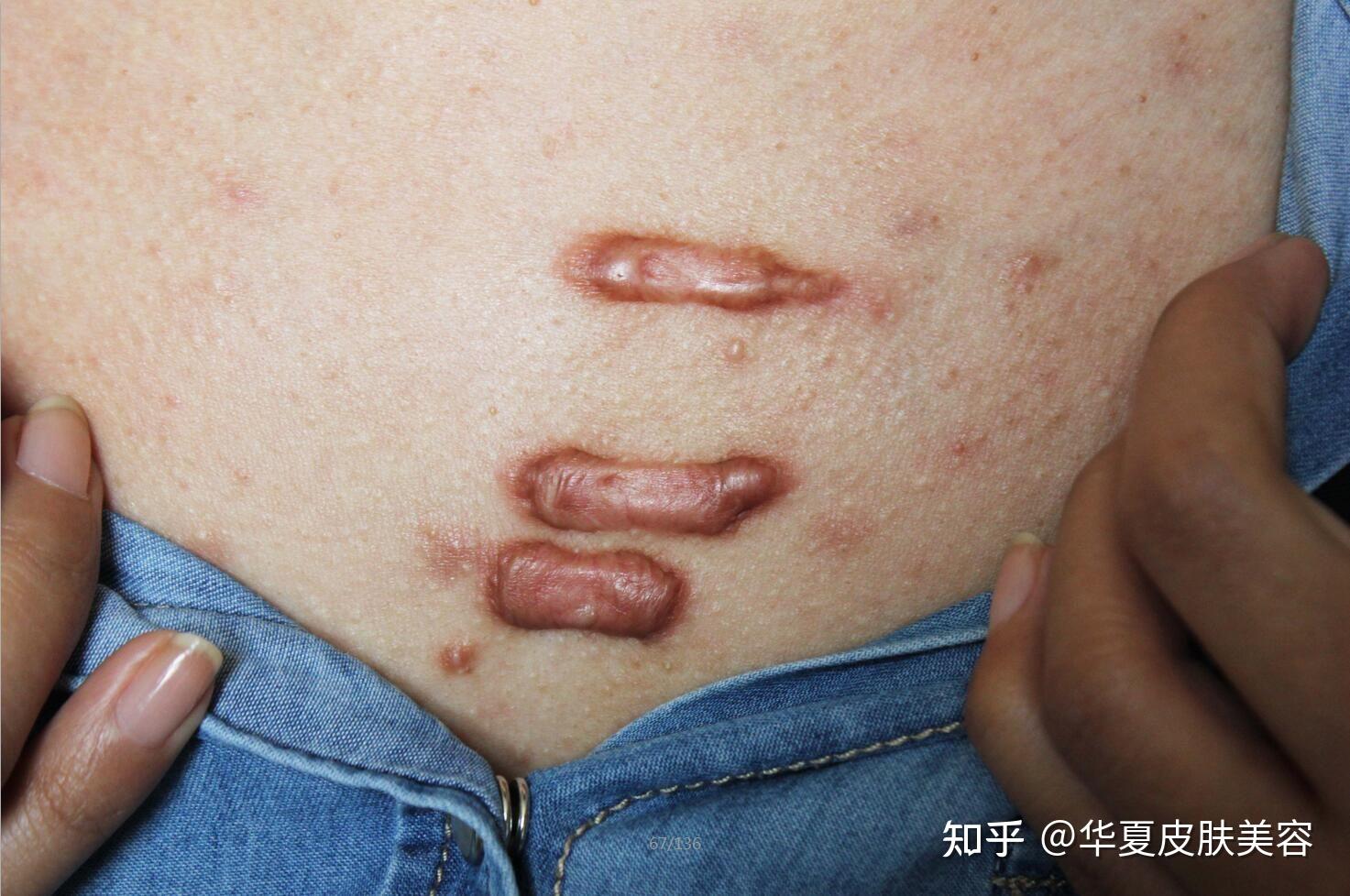 我受伤了容易留疤是不是疤痕体质呀