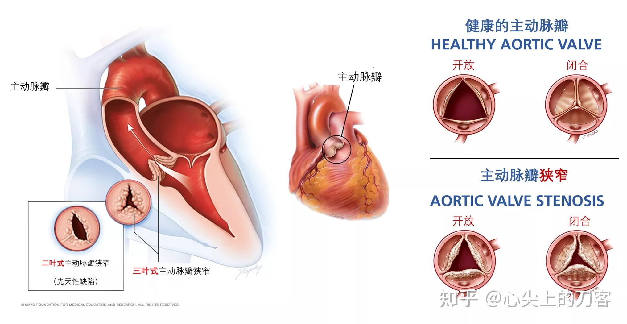 主动脉瓣上缩窄图片